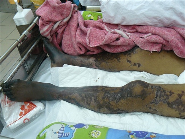 liên cầu lợn, liên cầu khuẩn, suy đa tạng, tiết canh