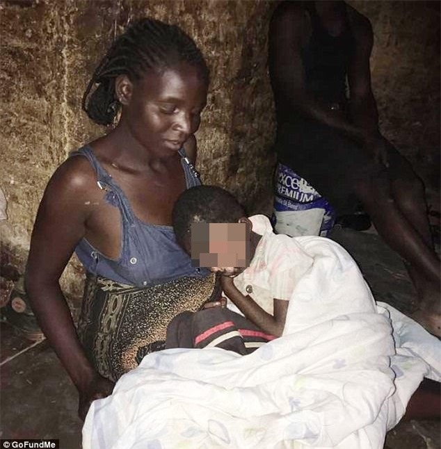 Be gai mat nua mat vi benh kho sac to da hinh anh 2