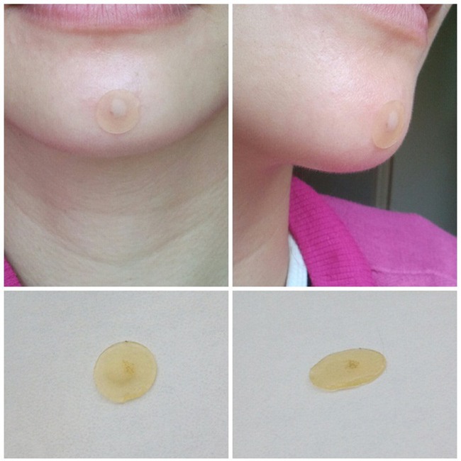 9 miếng dán mụn dễ mua dễ tìm lại tiêu diệt mụn nhanh gọn chỉ sau 72 giờ - Ảnh 19.