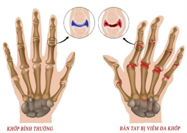 Biên tập viên bị hủy khớp tay do… gõ bàn phím quá nhiều - Ảnh 2.