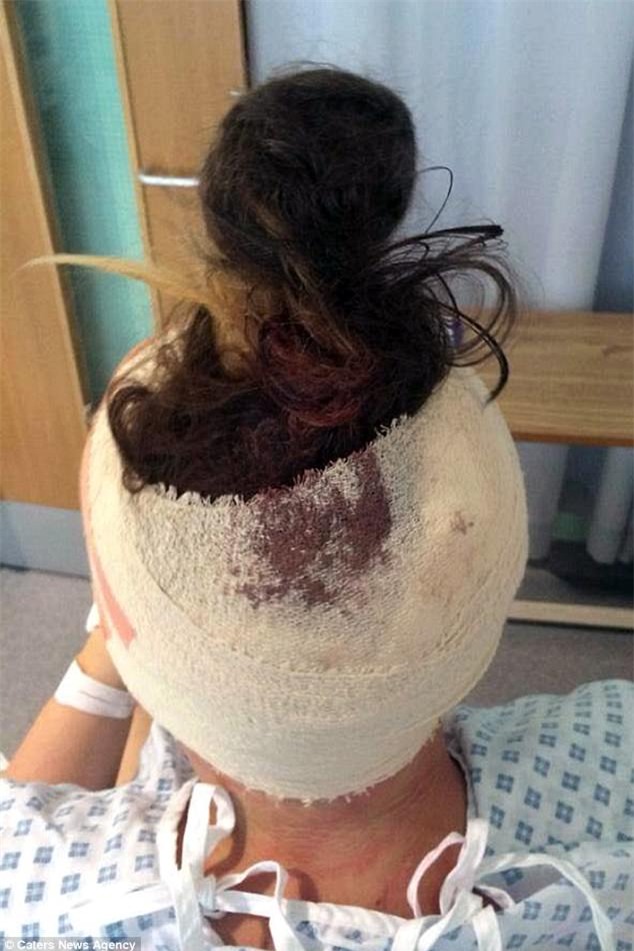 Chỉ 1 năm sau khi đặt que cấy tránh thai, cô gái trẻ bị tăng áp lực trong não, nhìn mờ và suýt tử vong - Ảnh 2.