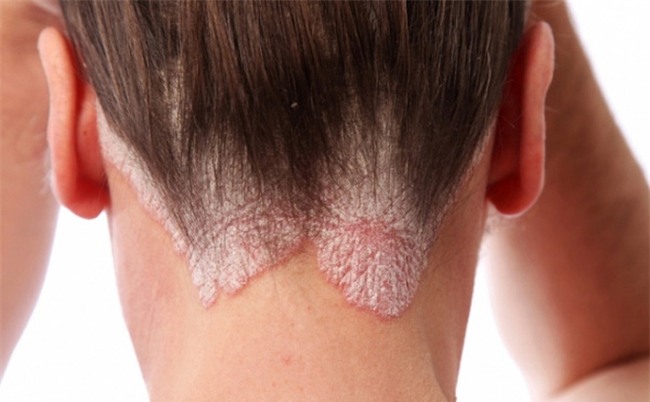 Khổ sở vì căn bệnh gây xấu xí, ngứa ngáy không dứt