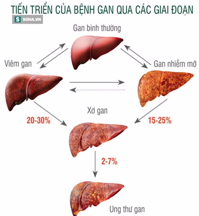 Giáo sư đầu ngành chia sẻ 6 bí quyết chăm sóc gan: Đừng để ung thư ra tay trước bạn - Ảnh 4.