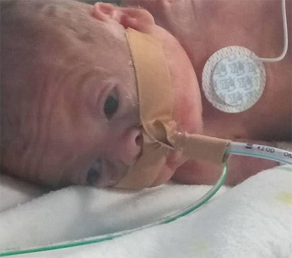 cap sinh non 4 thang, bac si noi ve lo hau su nhung ket qua that khong ngo - 3