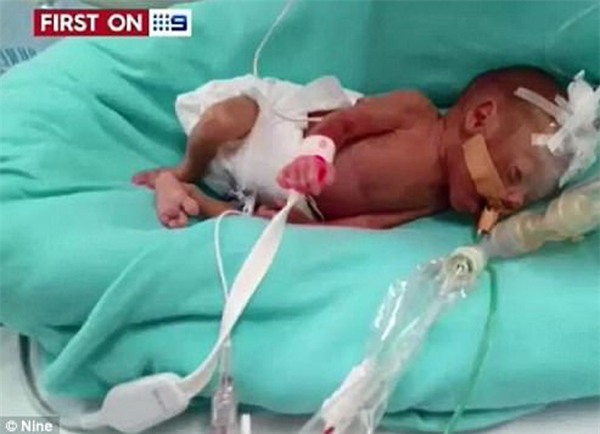 cap sinh non 4 thang, bac si noi ve lo hau su nhung ket qua that khong ngo - 4