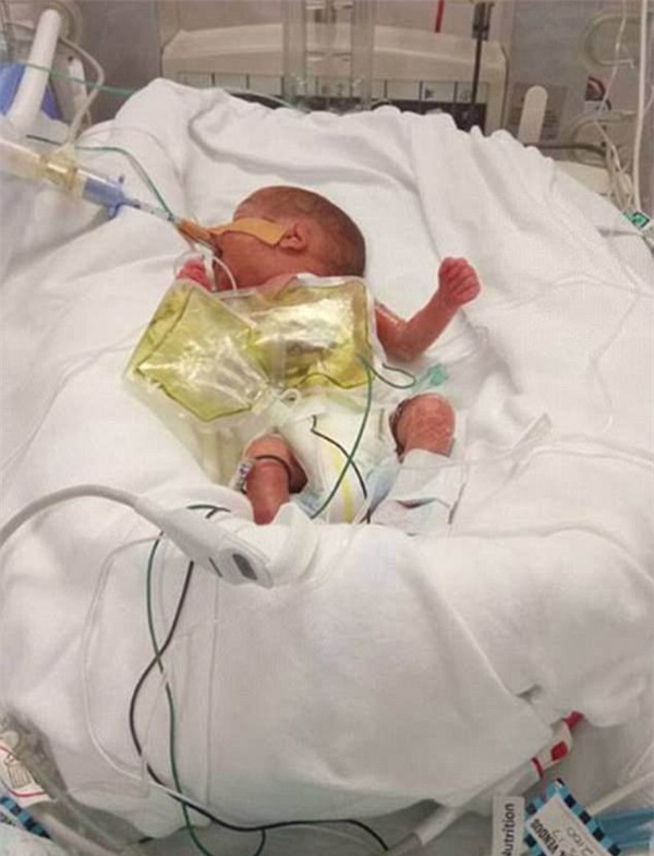 cap sinh non 4 thang, bac si noi ve lo hau su nhung ket qua that khong ngo - 5