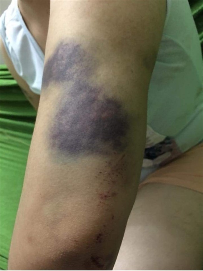 Nhiều vết thương trên cơ thể chị M vẫn còn bầm tím - Ảnh Facebook M.H