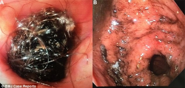 Vì thói quen kì quái, người phụ nữ khiến bác sĩ sốc khi lấy ra vật này trong dạ dày - Ảnh 2.