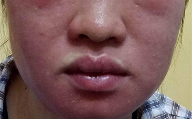Mặt “biến dạng” vì thần dược siêu trắng da