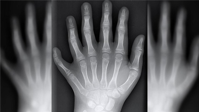 ki la: gia dinh ca 14 nguoi deu co 24 ngon tay, chan - 6