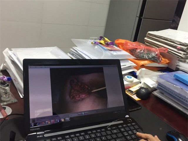 Bị loét vùng kín, quý ông tá hỏa phát hiện ung thư dương vật - 1