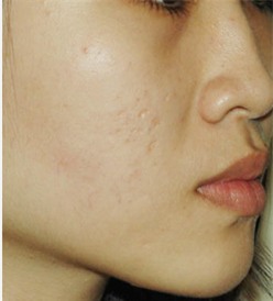 Điểm danh những loại sẹo mụn xấu xí làm chị em đau khổ và cách trị chuẩn khỏi chỉnh-1