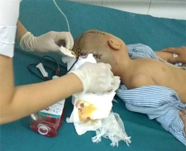 Cháu B. được mổ cấp cứu tại bệnh viện sau khi bị đập đầu vào cửa. Ảnh: (Gia đình cung cấp)