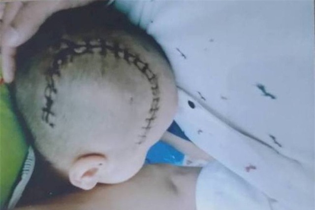 Vết mổ trên đầu cháu B. Ảnh: (Gia đình cung cấp)