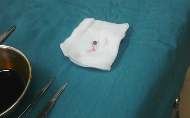 Hy hữu: Bé 16 tháng tuổi bị súng đồ chơi tự chế bắn vào bụng rách màng phổi