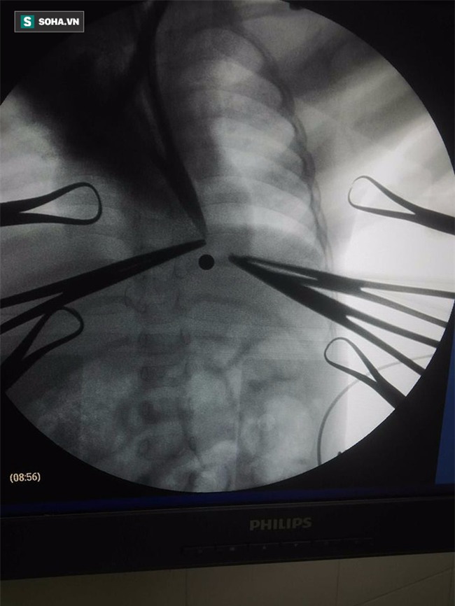 Hy hữu: Bé 16 tháng tuổi bị súng đồ chơi tự chế bắn vào bụng rách màng phổi - Ảnh 1.