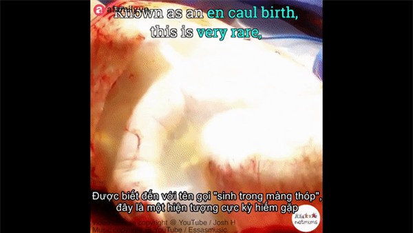 Cận cảnh em bé chào đời trong một ca sinh mổ hiếm gặp chỉ xảy ra với xác suất 1/80.000 ca - Ảnh 2.