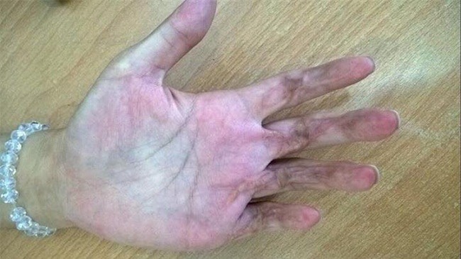 niem vui cua co gai tre co ban tay duoc tai sinh sau 2 nam dau don - 1