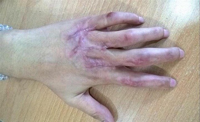 niem vui cua co gai tre co ban tay duoc tai sinh sau 2 nam dau don - 2