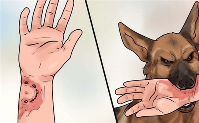 Vì sao chỉ từ 1 vết cắn mà có thể gây nhiễm trùng máu lấy đi mạng người?