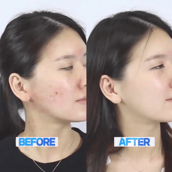 Hội mê làm đẹp nên update ngay: loại Ampoule rau má trị mụn và làm mờ thâm đang được con gái Việt thi nhau mua - Ảnh 3.