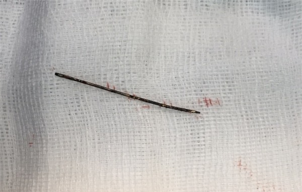 dị vật,bệnh viện Nhi,kim đâm