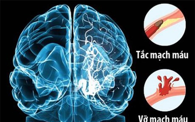đột quỵ,tai biến mạch máu não
