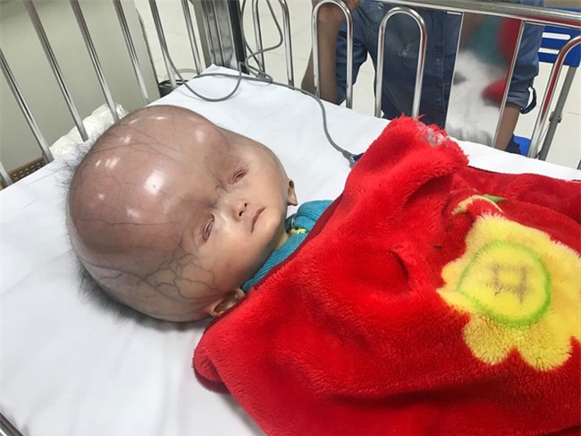 Mẹ của bé trai sinh ra có đầu to như quả bóng: Chồng và gia đình chồng đều bỏ mẹ con tôi - Ảnh 2.