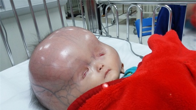 Vụ bé trai có cái đầu to khác lạ bị bố bỏ mẹ con đi lấy vợ khác: Tiên lượng xấu, gia đình xin về - Ảnh 2.