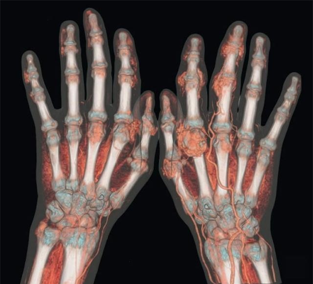 Căn bệnh nhà giàu gây đau đớn khủng khiếp: Đừng quên 10 nguyên tắc để phòng tránh - Ảnh 2.