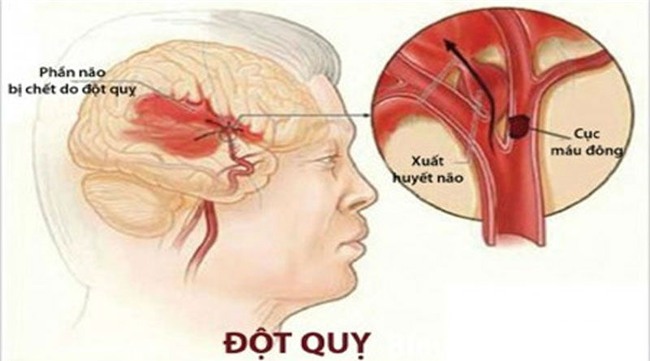 đột quỵ,tai biến mạch máu não