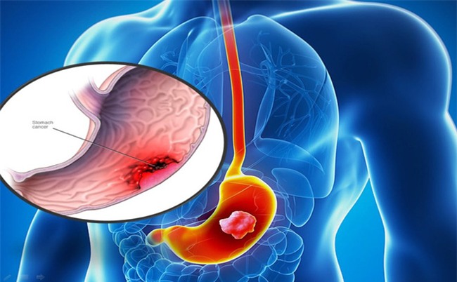 Ung thư dạ dày - 