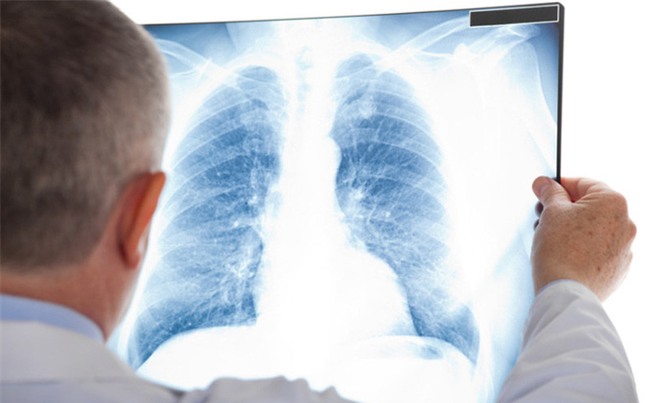 "Chụp X-quang nhiều mai mốt ung thư chết luôn": Đâu là sự thật?
