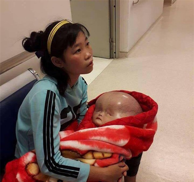 Người mẹ bị tố không đồng ý đưa con bị não úng thủy sang Singapore chữa trị lên tiếng
