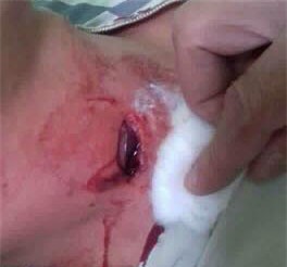 Nam thanh niên bị đạn găm trúng cổ khi đang nằm trong nhà