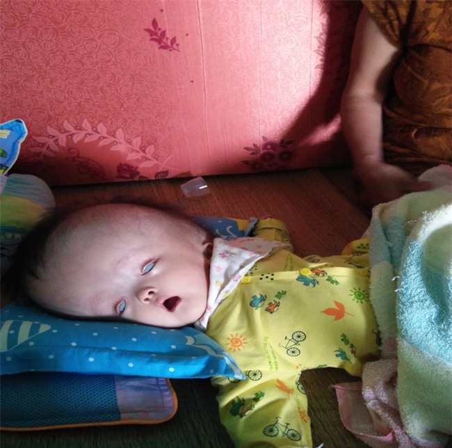 Cuộc sống đau đớn của bé gái 8 tháng tuổi mồ côi cha, cái đầu như muốn nổ tung vì căn bệnh não úng thủy