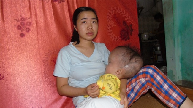 Cuộc sống đau đớn của bé gái 8 tháng tuổi mồ côi cha, cái đầu như muốn nổ tung vì căn bệnh não úng thủy