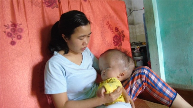 Cuộc sống đau đớn của bé gái 8 tháng tuổi mồ côi cha, cái đầu như muốn nổ tung vì căn bệnh não úng thủy