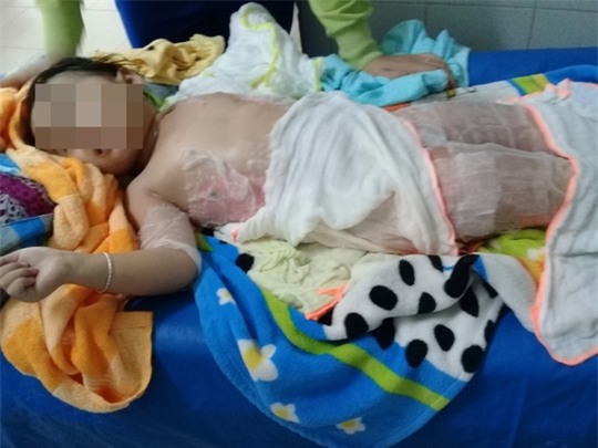 Dự tiệc nhà hàng, bé 3 tuổi bỏng nặng vì ngã vào nồi chè - Ảnh 1.