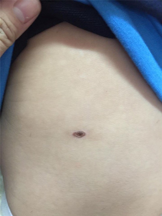 2 tre nguy kich cung co vet dot la o bung - 1