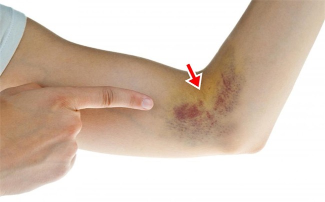 Bầm tím trên da: Chớ coi thường vì đây có thể là dấu hiệu các bệnh rất nguy hiểm