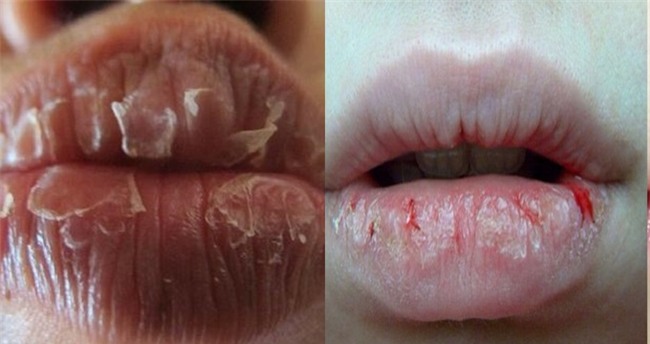 Moi 'nut toac', kho ne co nao, cu boi thu nay len la mem mai chi sau 1 dem