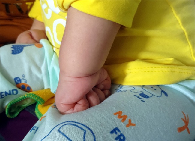 Xót thương bé gái hơn 1 tuổi bị côn trùng đốt khiến tay chân co quắp, teo não không thể nhận thức - Ảnh 4.