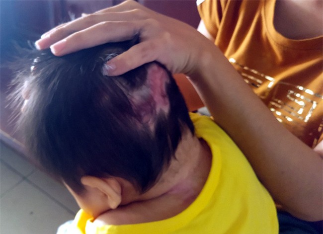 Xót thương bé gái hơn 1 tuổi bị côn trùng đốt khiến tay chân co quắp, teo não không thể nhận thức - Ảnh 6.