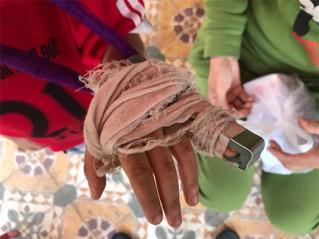 Công an vào cuộc làm rõ vụ cô giáo bị tố đánh gãy ngón tay bé trai 5 tuổi