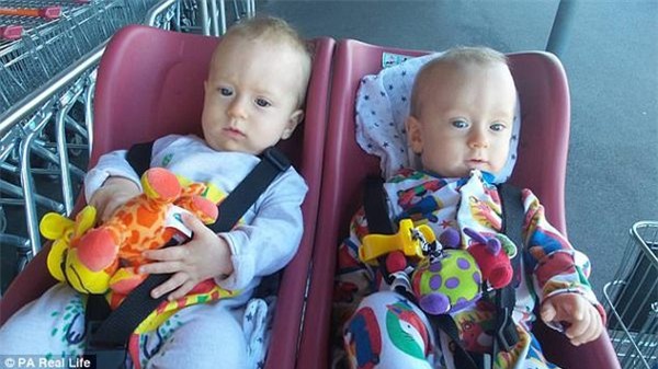 thai ky gap nguy hiem, hai be song sinh thoat chet nho om nhau trong bung me - 10