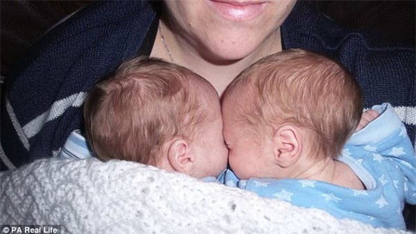 thai ky gap nguy hiem, hai be song sinh thoat chet nho om nhau trong bung me - 11