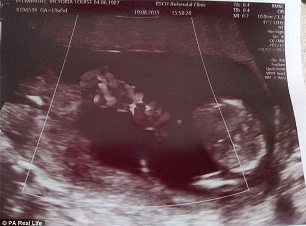 thai ky gap nguy hiem, hai be song sinh thoat chet nho om nhau trong bung me - 2