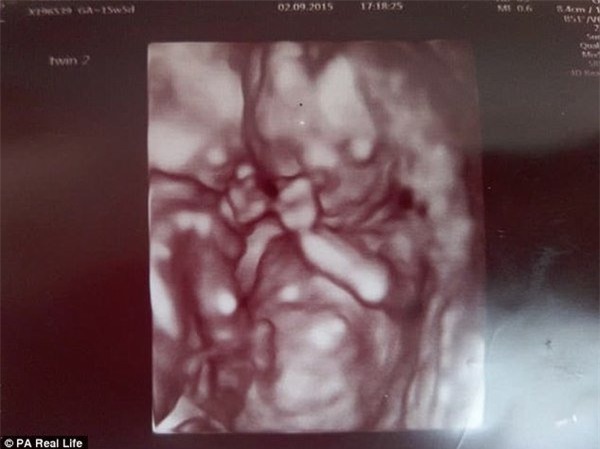 thai ky gap nguy hiem, hai be song sinh thoat chet nho om nhau trong bung me - 3