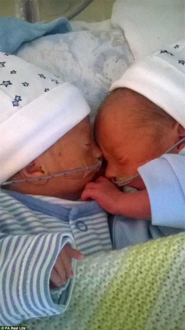 thai ky gap nguy hiem, hai be song sinh thoat chet nho om nhau trong bung me - 4